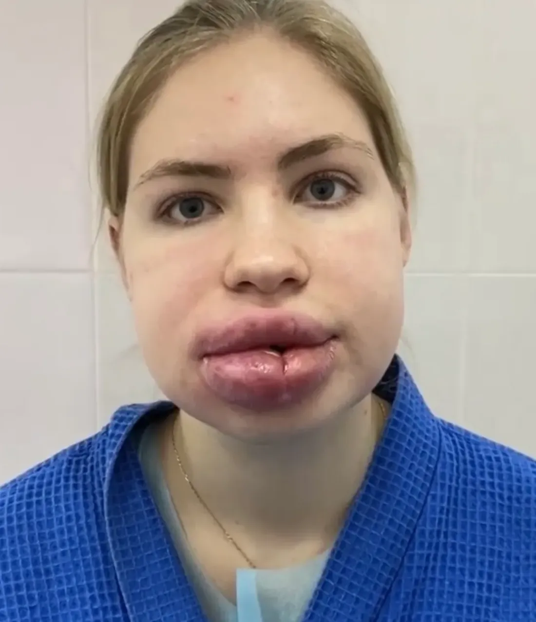 Хейлопластика — до
